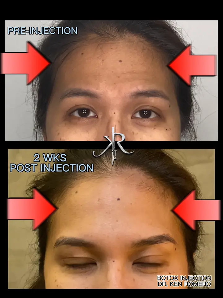 Botox: forehead, frown lines and crow’s feet, pre-injection and 2 weeks post-injection