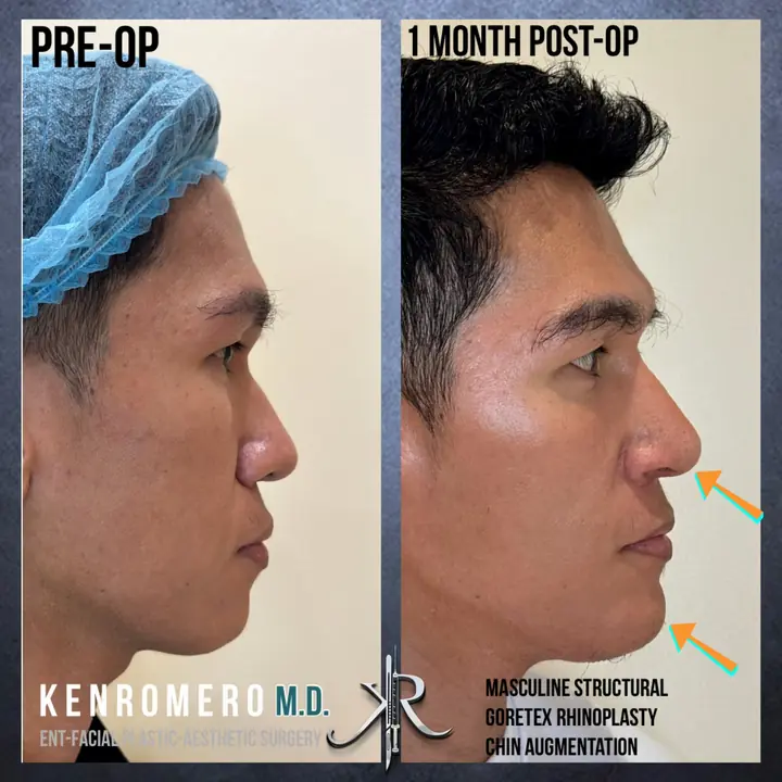 Chin Augmentation: profile, 1 month post-op, with structural rhinoplasty