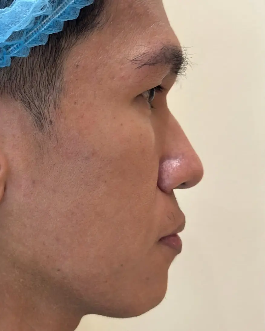 Rhinoplasty with Chin Augmentation, before