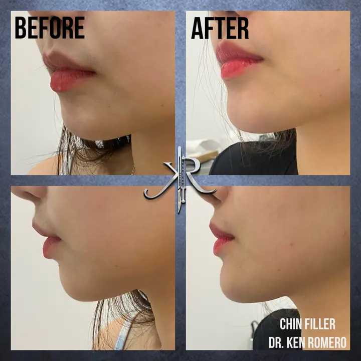 Chin Filler: oblique and profile, before and after