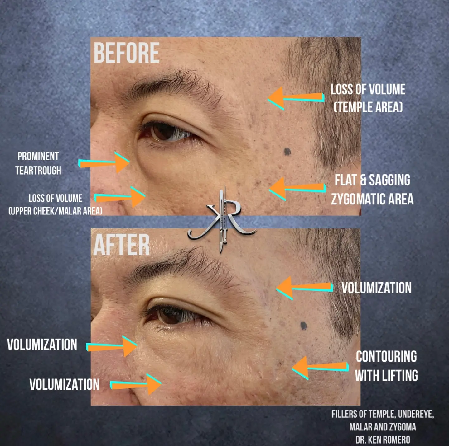 Facial Dermal Filler: oblique, before and after