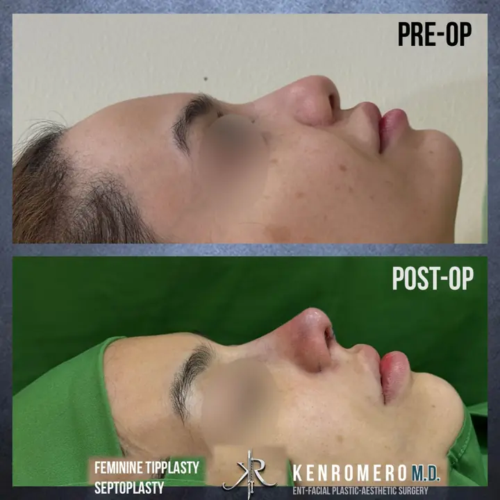 Feminine Tipplasty with Septoplasty: profile, pre-op and post-op