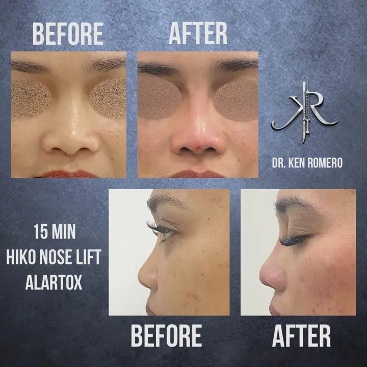 Hiko Nose Thread Lift: front and profile, before and after