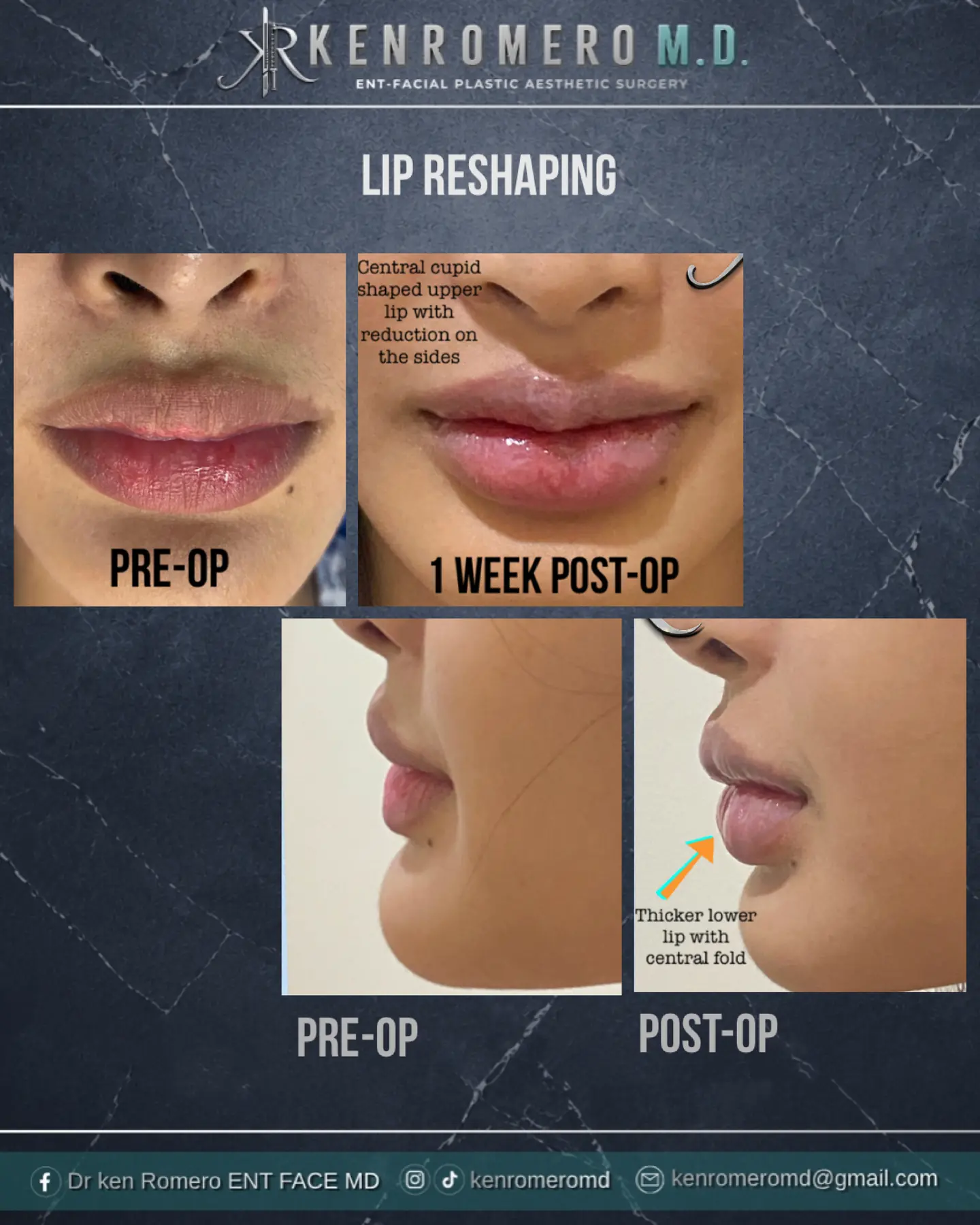 Lip Reduction & Reshaping: front and profile, pre-op and 1 week post-op