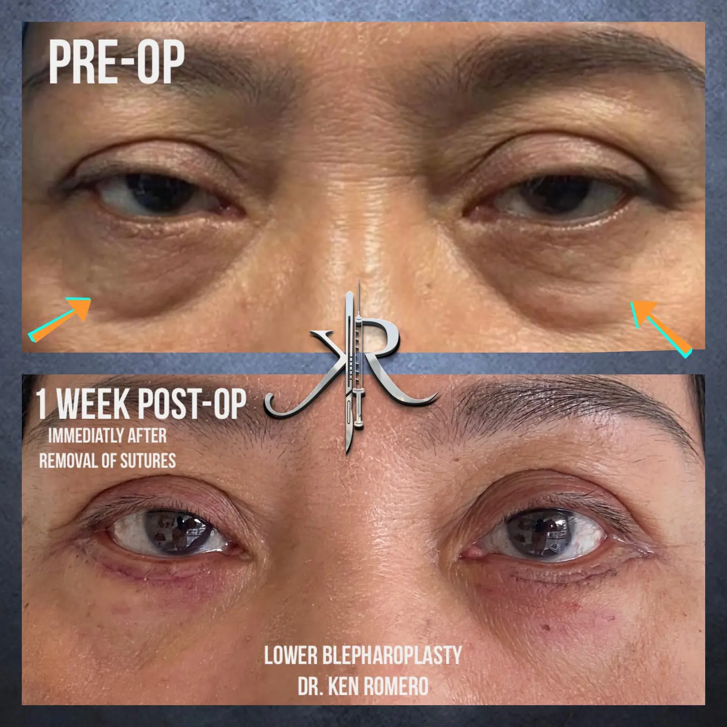 Lower Blepharoplasty: front view, 1 week post-op
