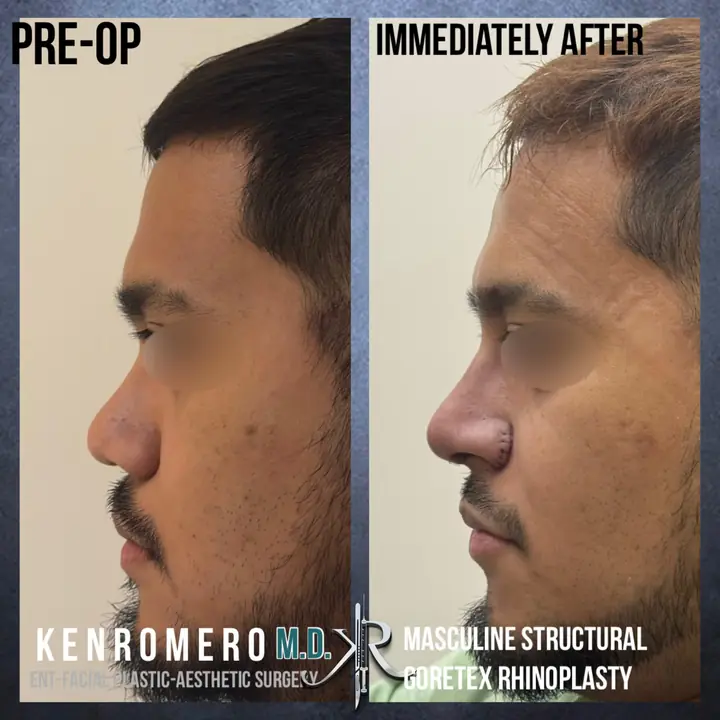 Masculine Structural Rhinoplasty: profile, pre-op and immediately after