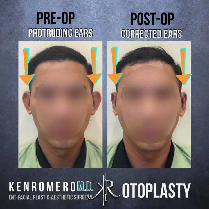 Otoplasty: front view, pre-op and post-op