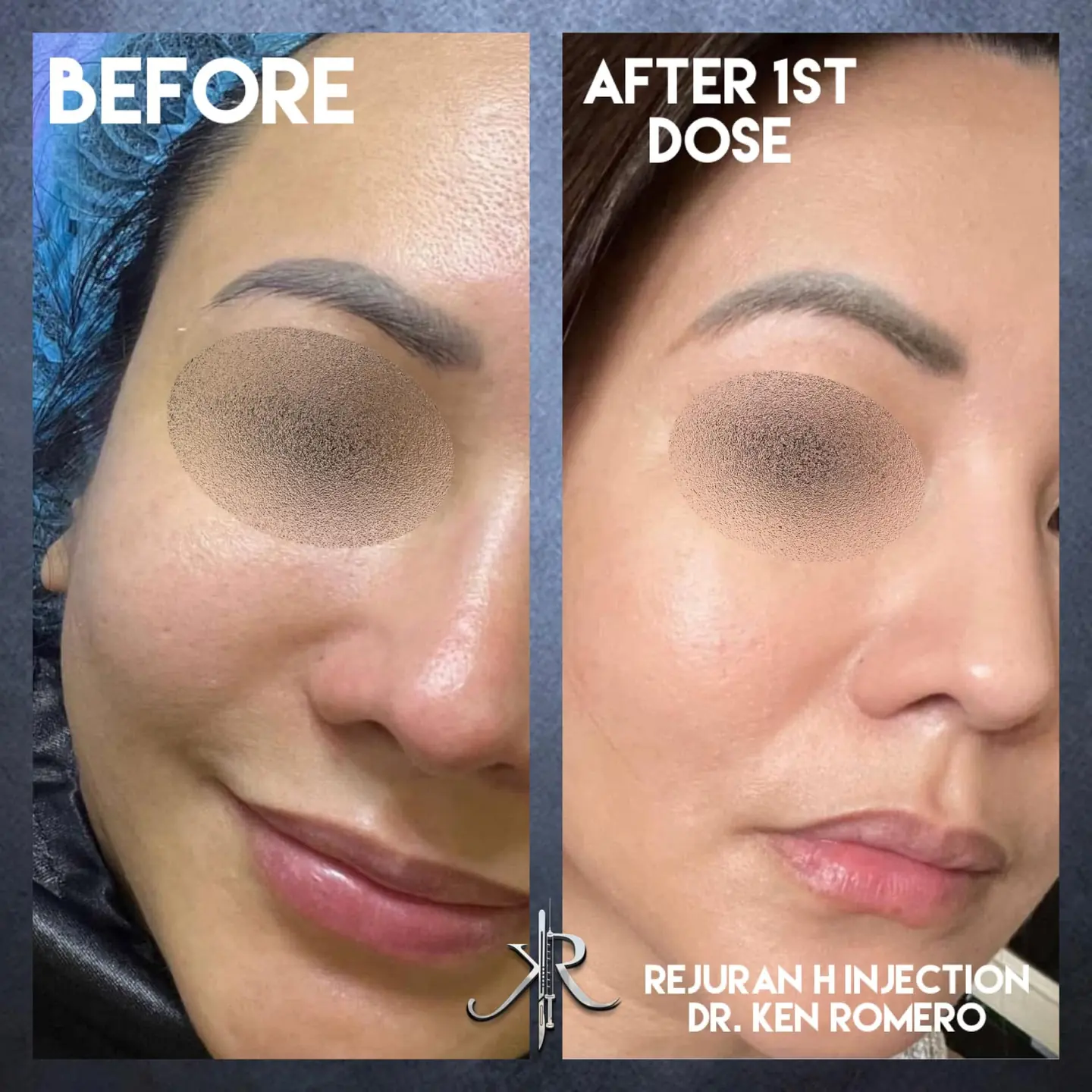 Skin Biostimulator: oblique, before and after 1st session