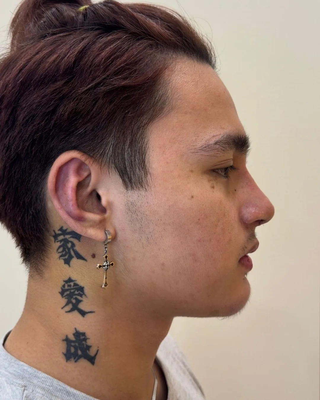 Profile, rhinoplasty with chin augmentation, after